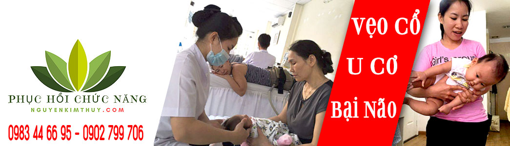 Vẹo cổ Bẩm Sinh